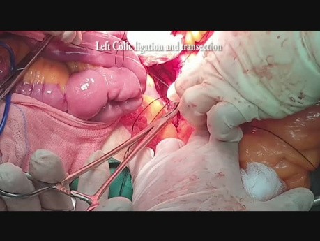 Épargner l'artère rectale supérieure (ouverte)