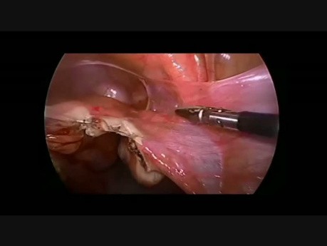 Résection Laparoscopique du Tube Utérin Tordu