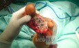 Amputation partielle du métatarse - pied diabétique, partie 1