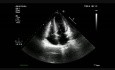 Une cardiomyopathie hypertrophique avec mouvement systolique antérieur (SAM) de la valve mitrale.