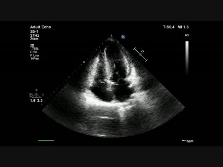Une cardiomyopathie hypertrophique avec mouvement systolique antérieur (SAM) de la valve mitrale.
