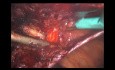 TAPP Ventrale Laparoscopique Associée à TAPP inguinale (Vidéo Annotée)
