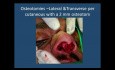 Cours de Rhinoplastie - Nez à Projection