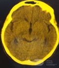  Ventriculostomie endoscopique du troisième ventricule dans un cas bénin du syndrome d'Aicardi avec hydrocéphalie obstructive et malformation de Chiari de type 1.