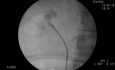 Chirurgie intrarénale rétrograde - Calcul du pôle inférieur du rein