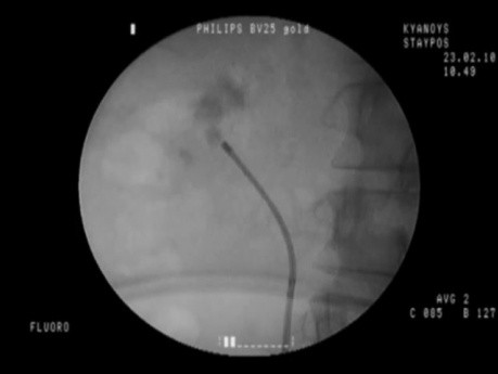 Chirurgie intrarénale rétrograde - Calcul du pôle inférieur du rein