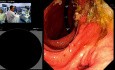 Dilatation à Double Ballonnet pendant la CPRE