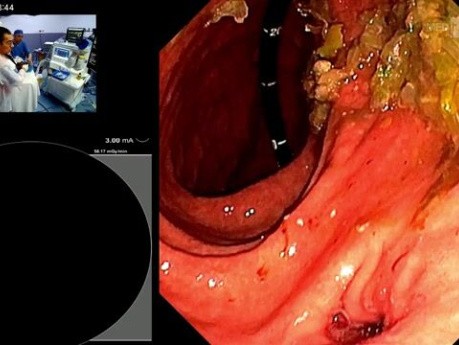 Dilatation à Double Ballonnet pendant la CPRE