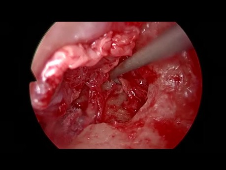 Tympanoplastie Endoscopique pour Otite Moyenne Chronique