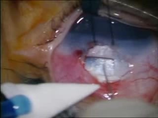 Trabéculectomie - glaucome congénital