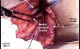 Dissection des Ganglions Lymphatiques Axillaires (ALND)