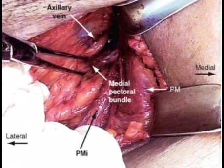 Dissection des Ganglions Lymphatiques Axillaires (ALND)