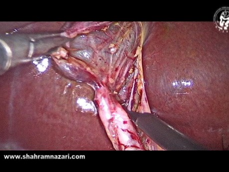 Cholécystectomie sans Cicatrice - Cholécystectomie Laparoscopique Pendant une Abdominoplastie