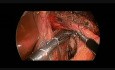 Cardiomyotomie de Heller par Laparoscopie compliquée d'une Perforation Oesophagienne