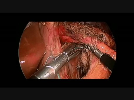 Cardiomyotomie de Heller par Laparoscopie compliquée d'une Perforation Oesophagienne