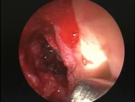 Une sphénoïdotomie antérieure - Endoscopie