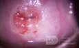 Colposcopie - CIN1
