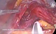 Myotomie de Heller Laparoscopique et Fundoplicature de Dor pour le Traitement de l'Achalasie
