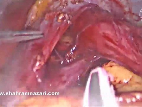 Myotomie de Heller Laparoscopique et Fundoplicature de Dor pour le Traitement de l'Achalasie