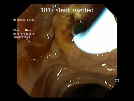 Couteau à Aiguille CPRE Stent 10 Fr Retiré