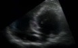 Echographie en cas de cardiomyopathie hypertrophique