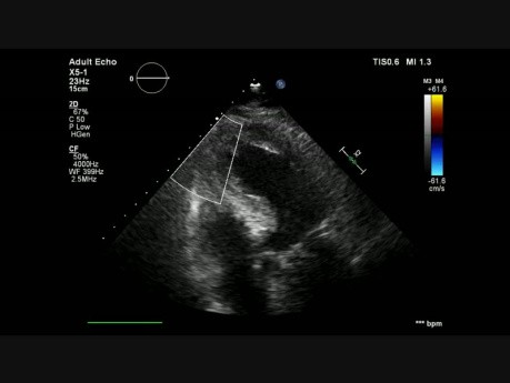 Rupture du septum interventriculaire après infarctus antérieur