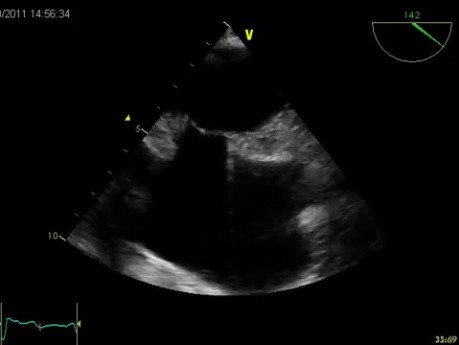 L'hypertrophie lipomateuse du septum interatrial (SIA) - Vidéo n ° 2