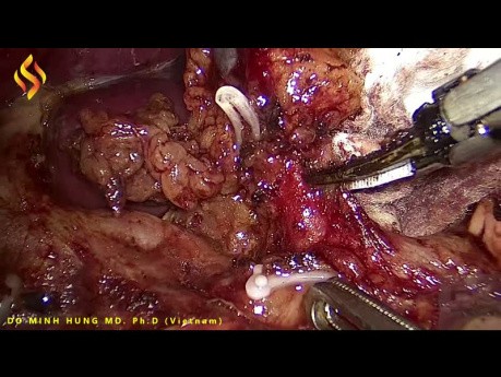 Dissection laparoscopique des ganglions lymphatiques de la région suprapancréatique pour le cancer gastrique