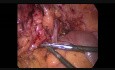 Sigmoïdectomie laparoscopique en raison de la diverticulite compliquée de fistule colovaginale