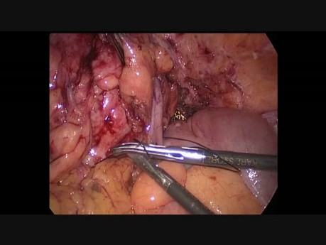 Sigmoïdectomie laparoscopique en raison de la diverticulite compliquée de fistule colovaginale