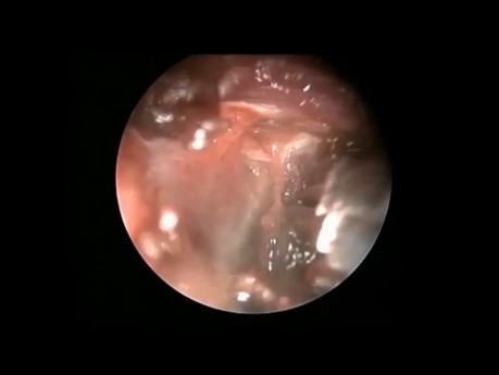 Ablation endoscopique de l'hémangiome caverneux de la fosse infratemporale par antrostomie méatale inférieure