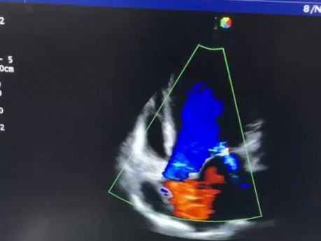 13. Cas d'échocardiographie - Qu'est ce que vous voyez ?