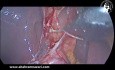 Anatomie du Sillon de Rouvière per Cholécystectomie Laparoscopique