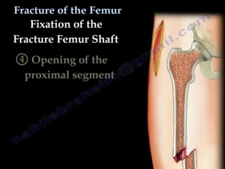 Fracture du fémur