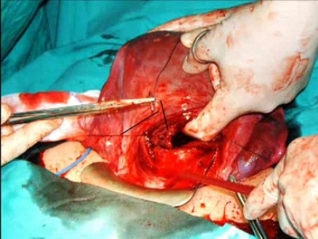 Technique de suture B-Lynch pour l'hémorragies du post-partum