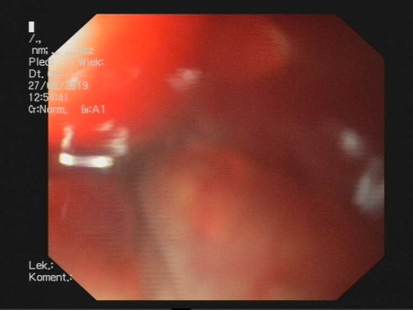 Gastroscopie chez un patient atteint du syndrome de Boerhaave