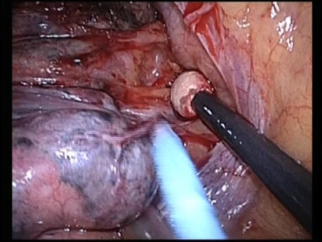 Dissection du Lobe Pulmonaire Azygos - Vidéo-Thoracoscopie Uniportale