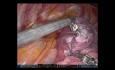 Tri-segmentectomie pulmonaire du lobe supérieur gauche S1-3