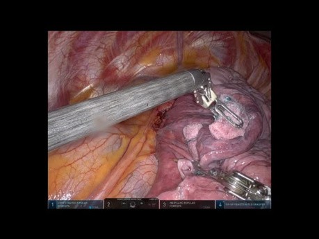Tri-segmentectomie pulmonaire du lobe supérieur gauche S1-3