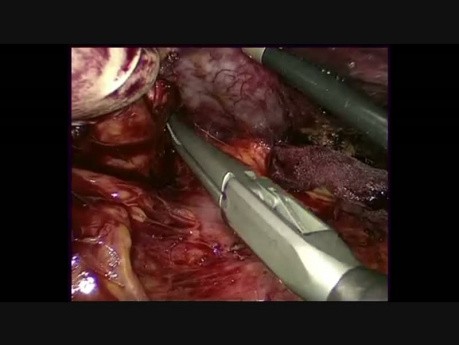Splénectomie laparoscopique manuellement assistée avec une exérèse des organes multiples