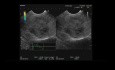 Tumeur pseudopapillaire du pancréas, écho-endoscopie