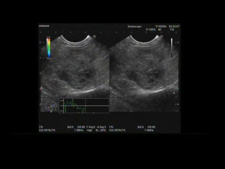 Tumeur pseudopapillaire du pancréas, écho-endoscopie