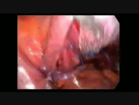 Sacrocolpopexie laparoscopique