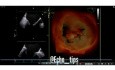 Échocardiographie - Prolapsus de la valve mitrale avec rupture de la chorde et analyse de la fonction ventriculaire gauche par Speckle Tracking